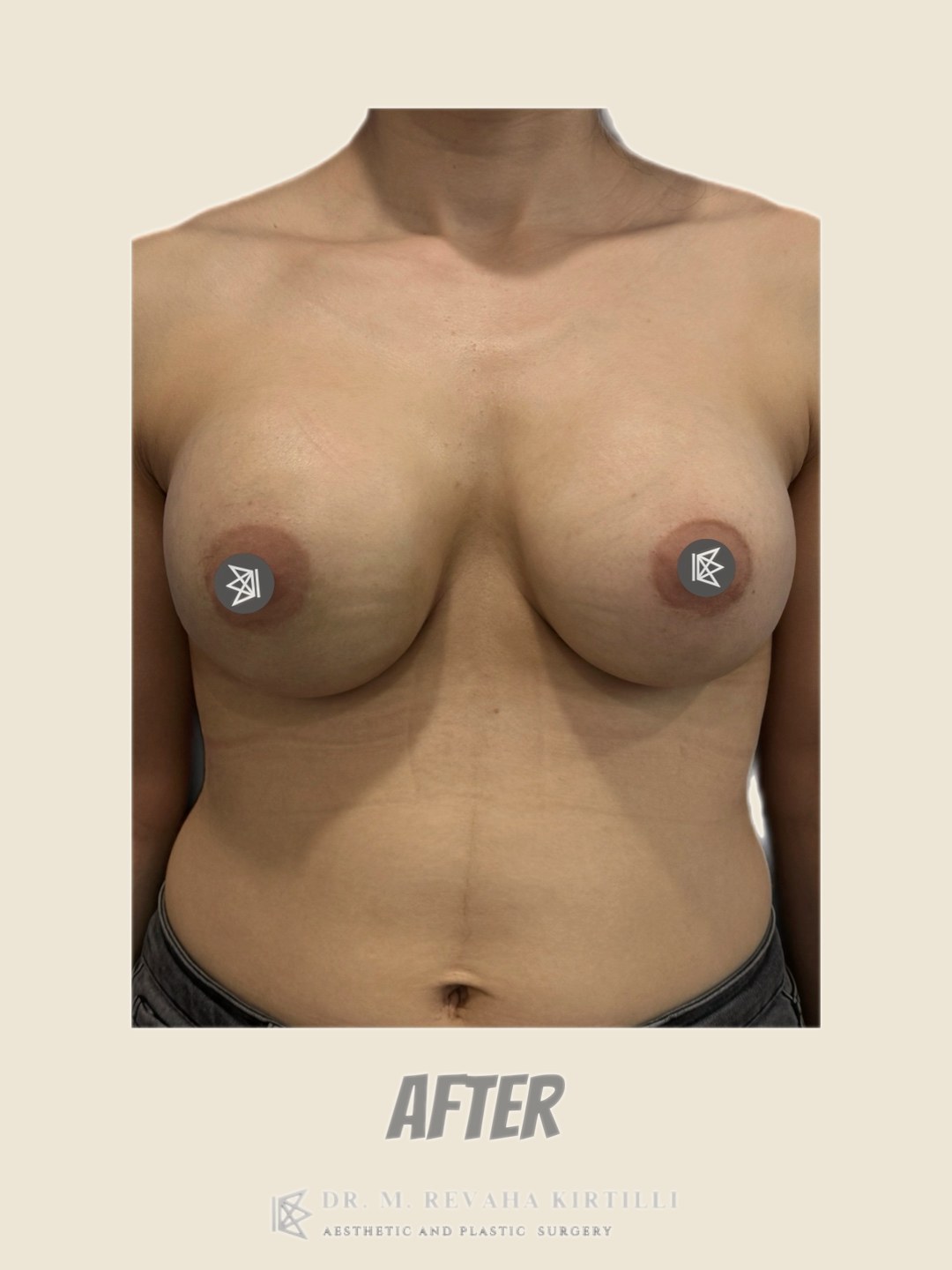 After — Breast Augmentation