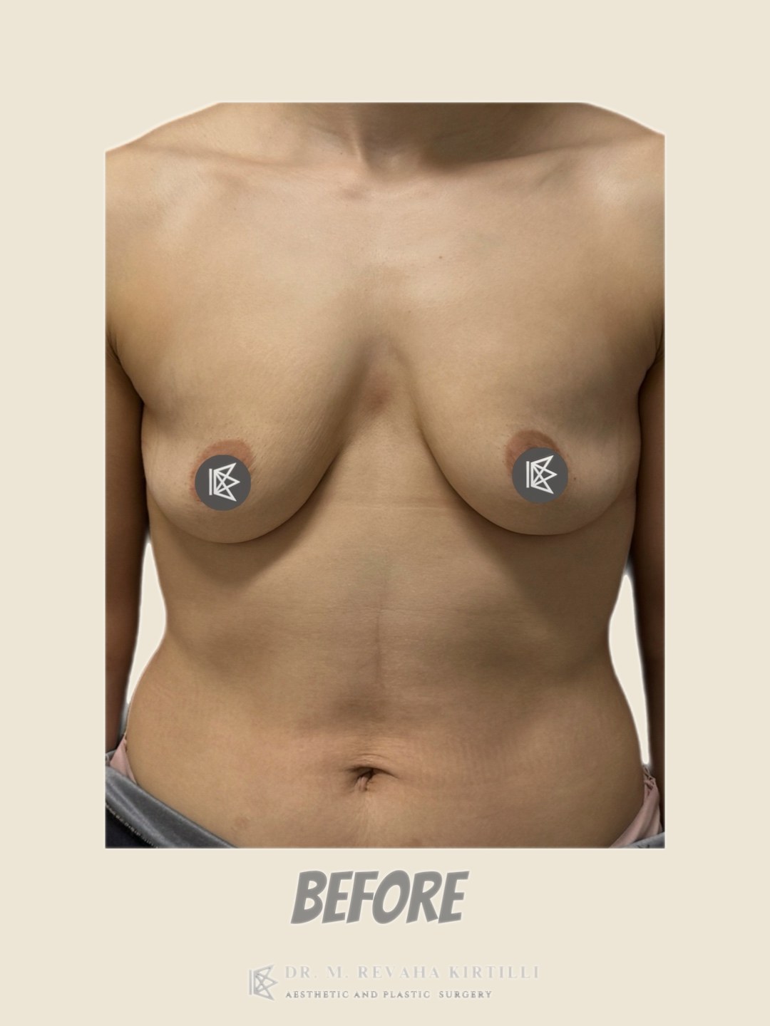 Before — Breast Augmentation