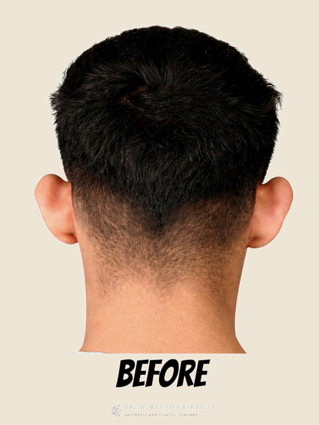 Antes — Otoplastia — Orejas Prominentes