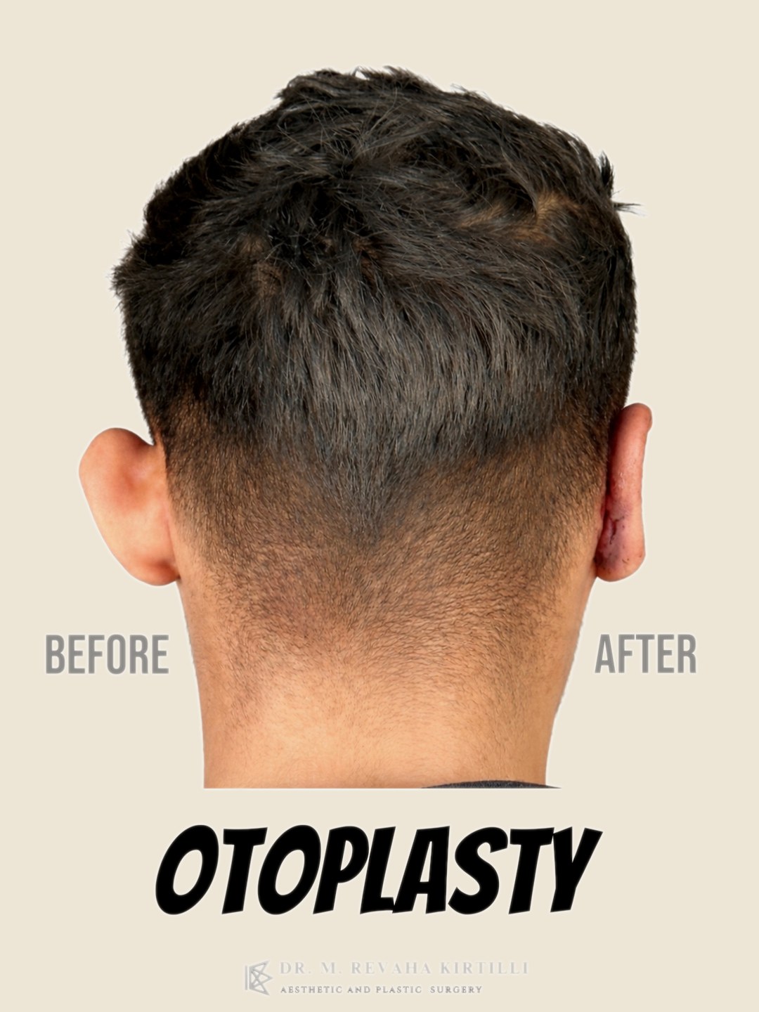 Comparación — Otoplastia — Orejas Prominentes